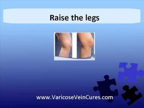 how to get rid veins on feet