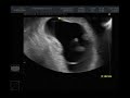 Ultrasound 10 weeks 4 days