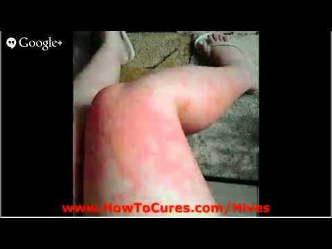 how to cure idiopathic urticaria