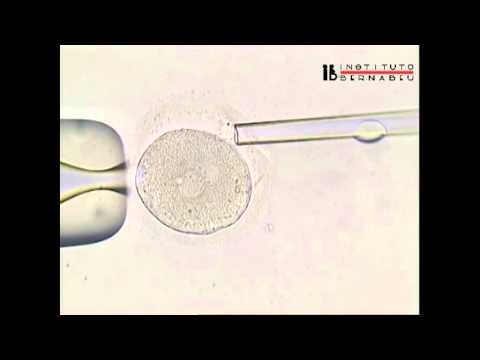 Biopsias segundo corpúsculo polar. Biopsia de CPs para DGP