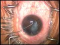 cataract surgery milky white liquid cataract Uday Devgan MD