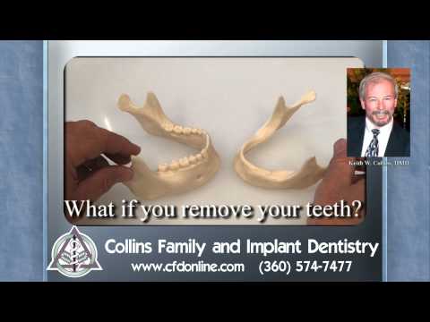 What happens if you remove all of your teeth?  By Keith Collins, DMD in Vancouver, WA