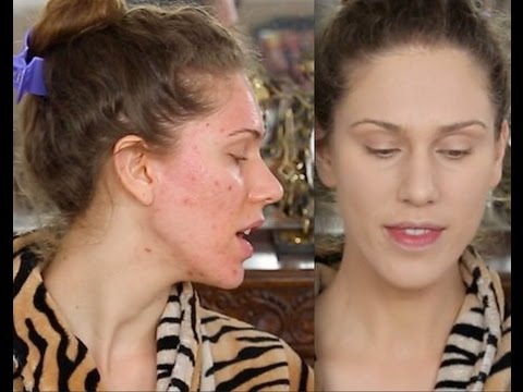 how to hide acne scars