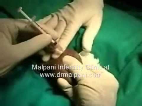 how to recover sperm