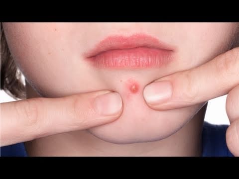how to properly pop a pimple
