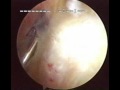 Arthroscopic Shoulder Surgery