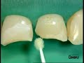 Dentply - Prime&Bond Nano Technology Dental Adhesive