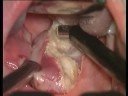 tonsillectomy