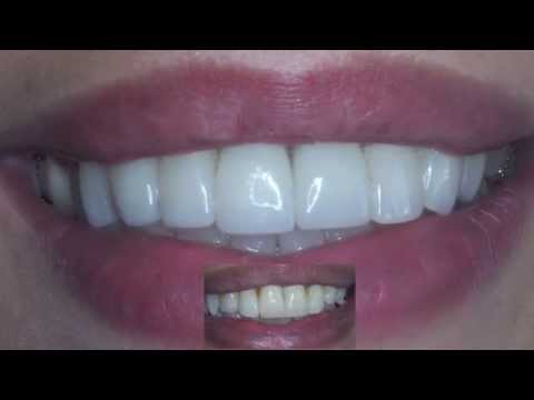 gencive - http://dr-assayag-nadine.chirurgiens-dentistes.fr/ Les facettes dentaires ont une grande influence sur la qualité de la gencive. Grâce à leur excellente adap...