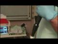 videos de Colonoscopy with Megachannel Colonic Access Device for NOTES procedures