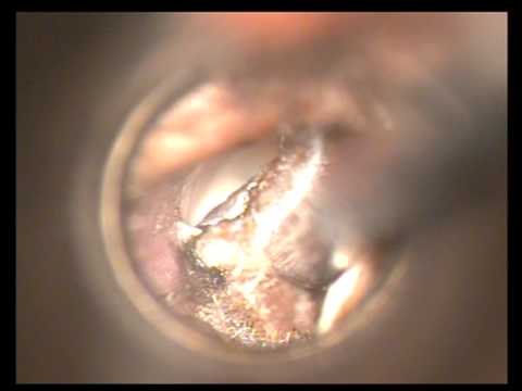 how to remove ear fungus