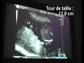 Echographie des 4 mois - 17 08 07 Echographie des 4 mois - 17 08 07