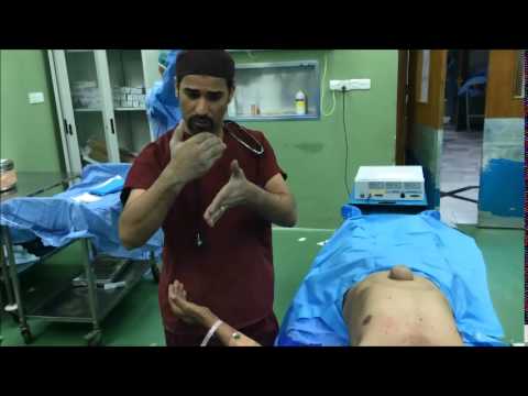 how to remove epidural catheter