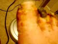 Video of Frostbitten feet