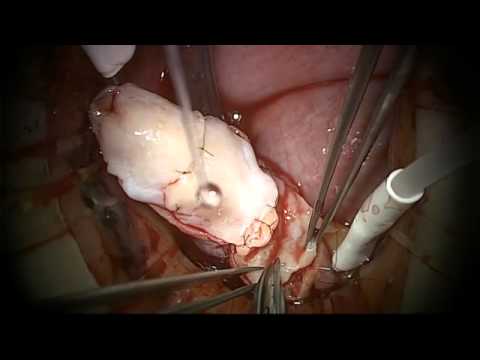 how to get an ovary transplant