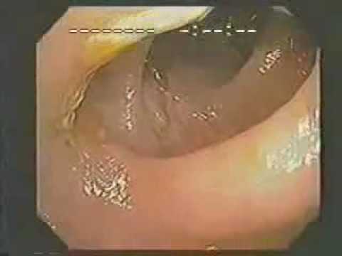 how to unclog small intestines