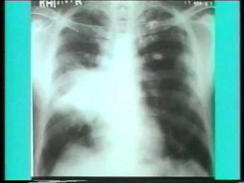 how to properly read a chest x ray