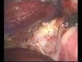Laparoscopic supracervical hysterectomy