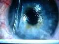 GETTING LASIK EYE SURGERY