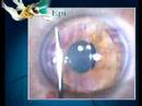 Epi-Laser Procedure Epi-Laser Procedure