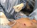 Live Breast Augmentation Surgery Demonstrated by Dr. Loftus