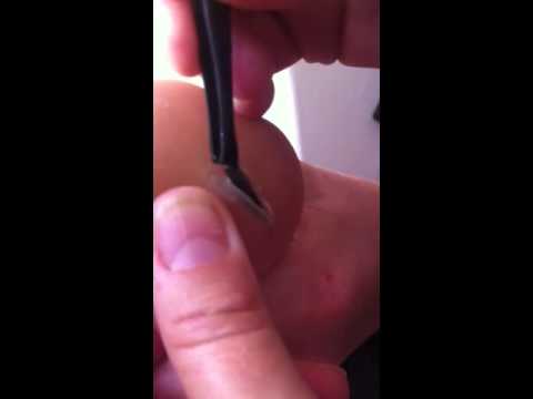 how to remove sliver