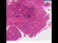 Histopathology Lung--Aspiration pneumonia, infant