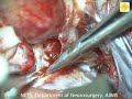 Neurosurgery video clinoidal aneurysm clipping