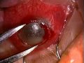 Amniotic Membrane - Orange County LASIK Surgeon Dr Ghosheh