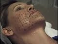 Thermage