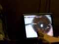 Operacion de Cataratas Cirujia cataract surgery intraocular lens