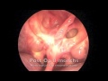 Endoscopic Reconstruction of Skull Base by the Use of Nasoseptal Flap Endoscopic Reconstruction of Skull Base by the Use of Nasoseptal Flap