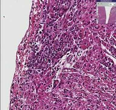 how to treat coxsackie b virus