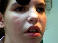 strabismus 