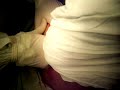 multiple fibroid uterus