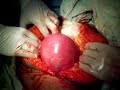 multiple fibroid uterus