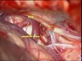 Brain tumor-cerebello-pontine angle EPIDERMOID-microsurgry-dr suresh dugani/HUBLI/INDIA