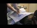 Bone Marrow Biopsy 2