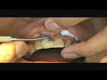 Carlson Dental Bridge�