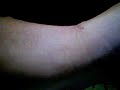 A scar A scar