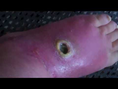 how to treat infected cut