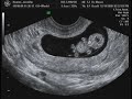 Compilation 9 weeks 2 days Ultrasound