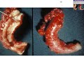 Histopathology Acute Appendicitis