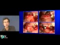 Nouvelles Perspectives En Augmentation Osseuse Par Le Dr. Georges Khoury