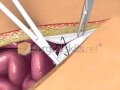 LAPAROTOMY CLOSURE