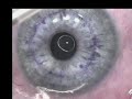 Conductive Keratoplasty Conductive Keratoplasty