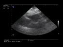 CARDIAC_Traumatic tamponade with clot