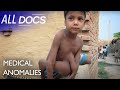 The 8 Limbed Boy - Parasitic Twin | Extraordinary People Documentary | Documental