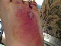 foot surgery