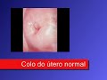 O RASTREIO DO CANCRO DO COLO UTERINO